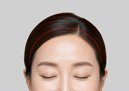 Coronal Forehead Lift - Scalp Incision