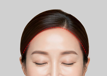 Forehead Reduction Lift - Hairline Incision