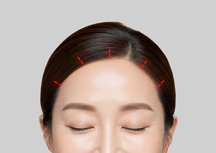 Endoscopic Forehead Lift - Minimal Incisions Inside the Hairline