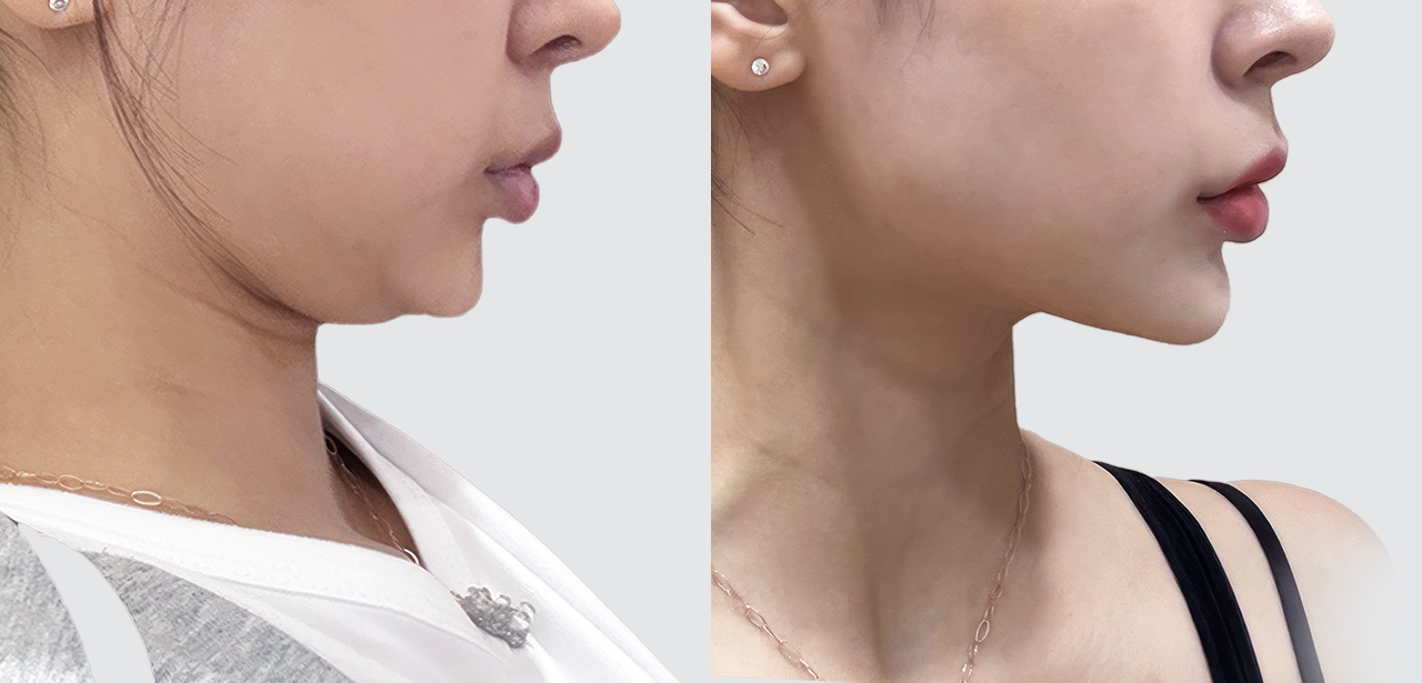 Before and after comparison