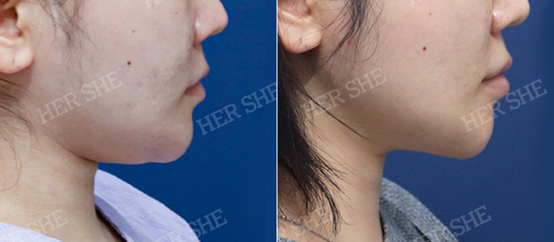 Before and after