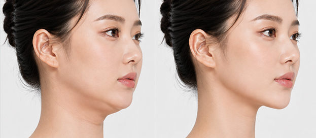Before and after