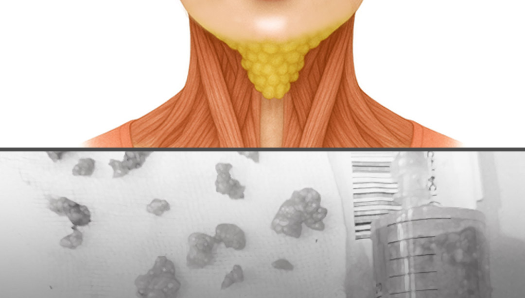 Removing Clustered Fat, a Cause of a Heavy Double Chin
