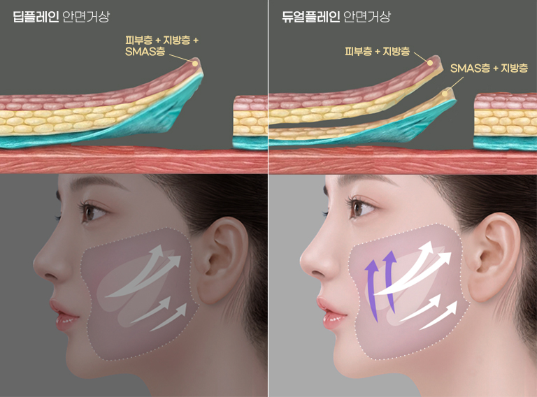 Key Points of HERSHE Dual Plane Facelift
