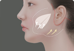 Procedure