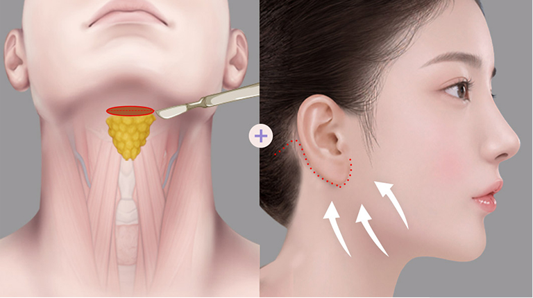 All-in-One Double Chin Muscle Tightening + Mini Facelift