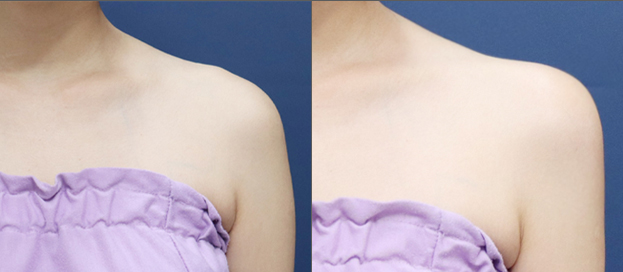 Shoulder filler before and after
