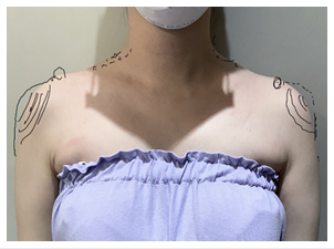 Sloped shoulders