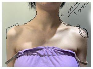 Angular shoulders with prominent clavicle ends