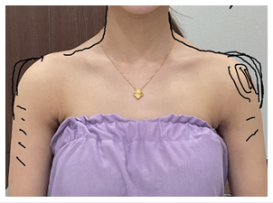 Shoulders that appear narrow due to thicker upper arms