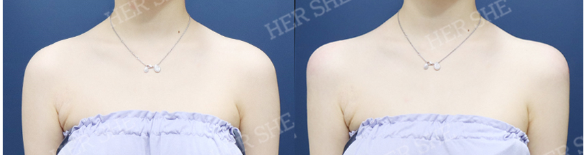 BEFORE & AFTER