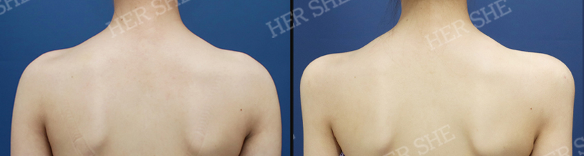 BEFORE & AFTER