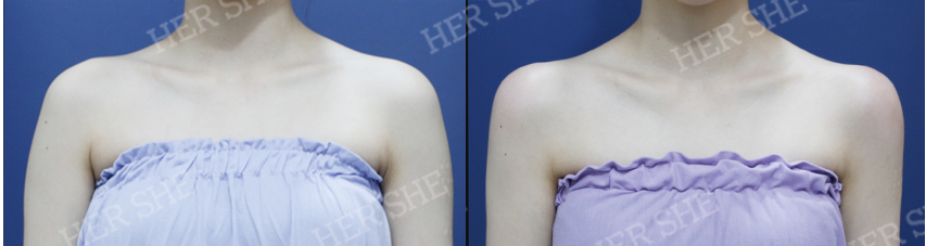 BEFORE & AFTER