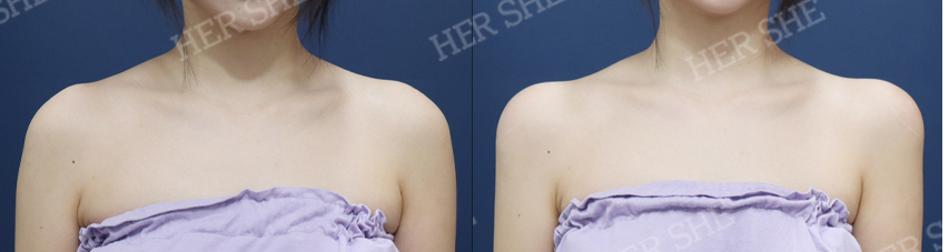 BEFORE & AFTER