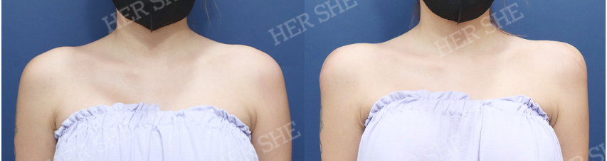 BEFORE & AFTER