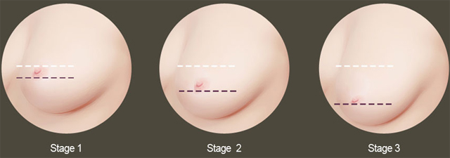 Breast sagging How To