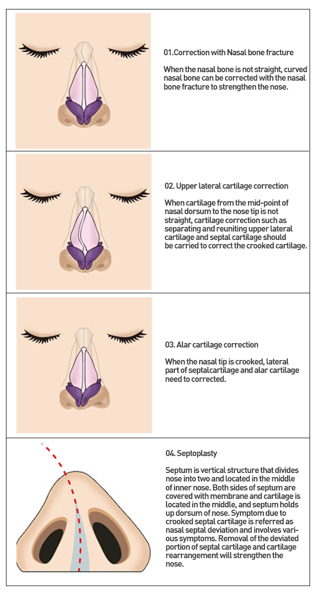 septal cartilage